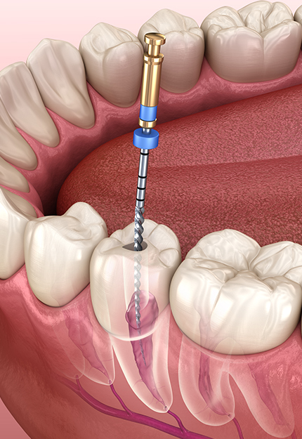 YONSEI 자연치아 살리기
