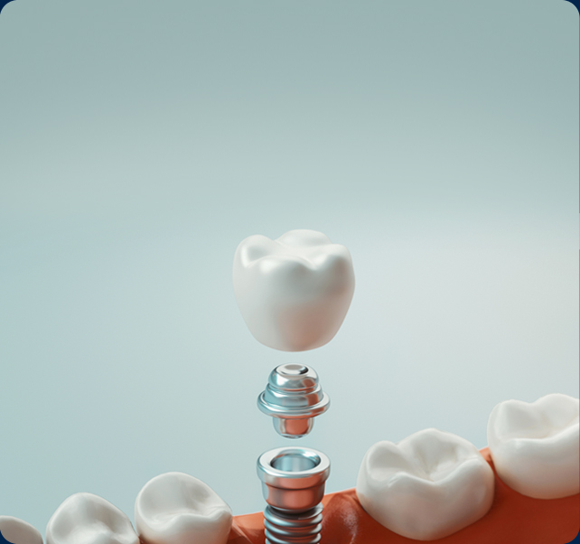 임플란트